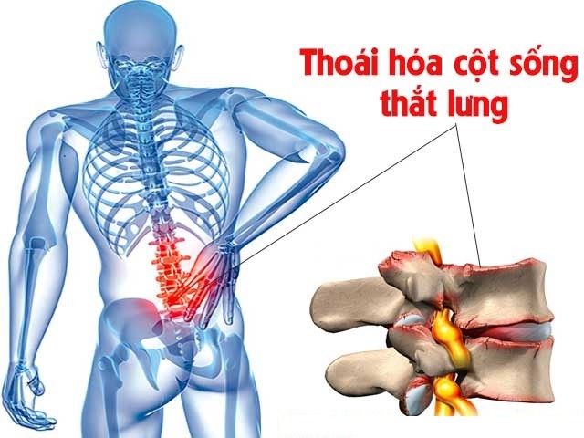 Phương pháp massage bấm huyệt trị thoái hóa cột sống